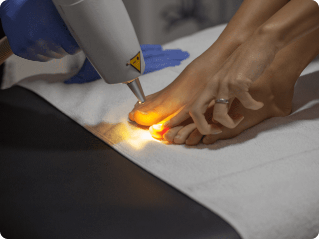 Laser treatment being applied to a toenail.